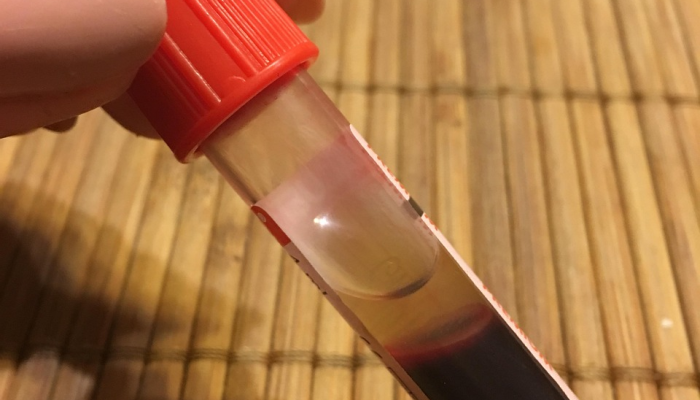 工程师发明了一种可以诊断牙龈炎的家庭测试 工程师发明了一种可以诊断牙龈炎的家庭测试